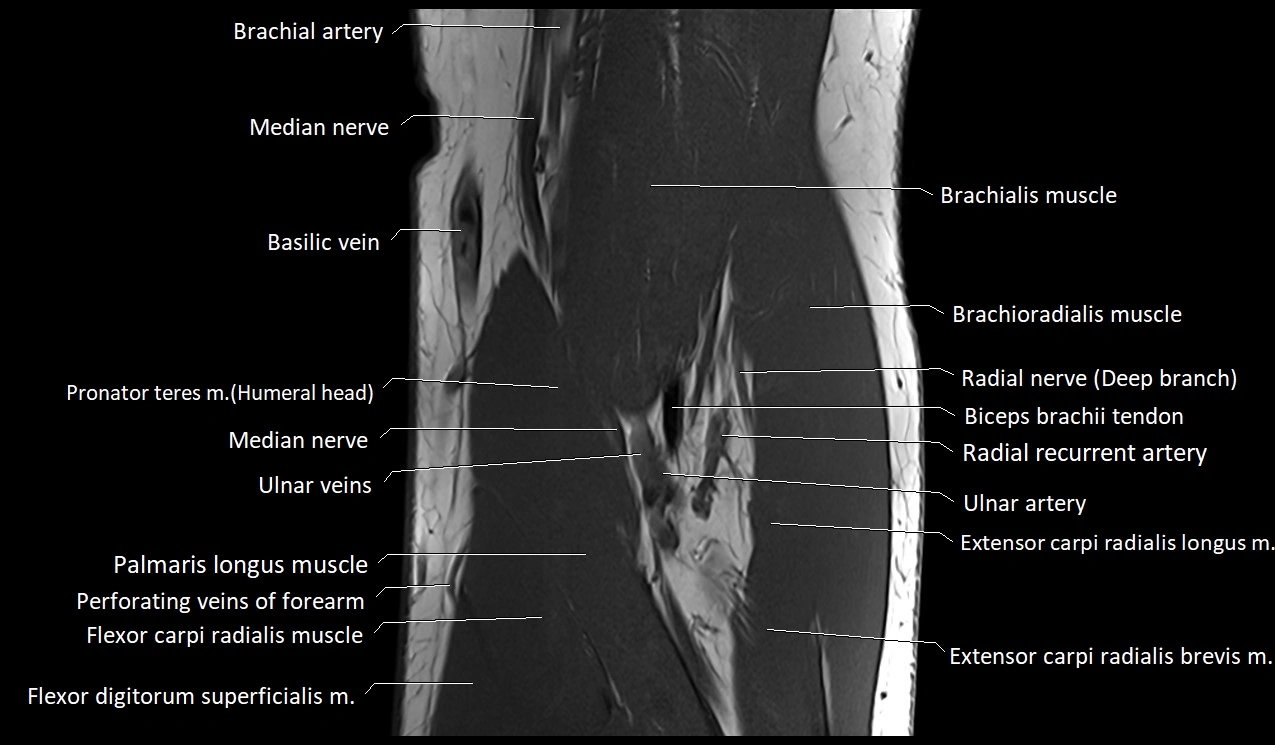 Elbow coronal anatomy image  cross sectional 3T MRI image 11.webp